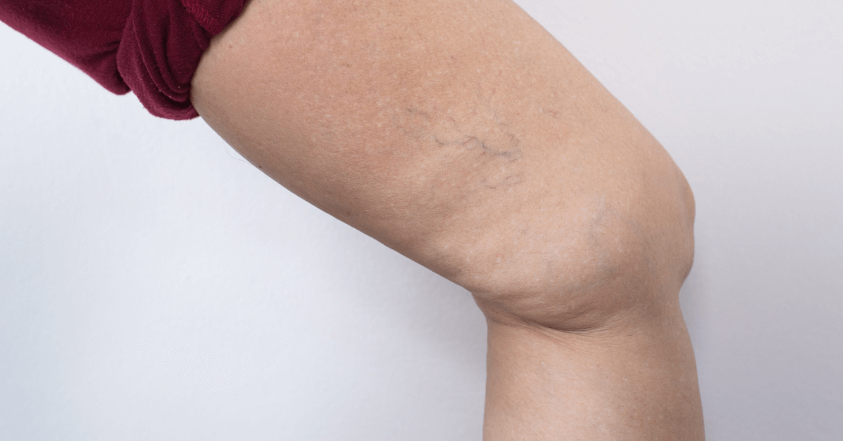 Learn When To Look Into Spider Vein Removal After Your ...